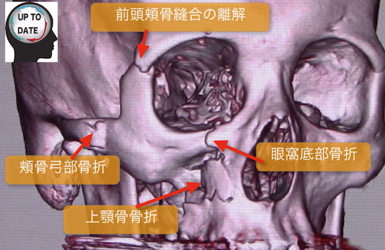 頬骨上顎複合骨折の画像診断(顔面骨骨折、ZMC骨折とは？)
